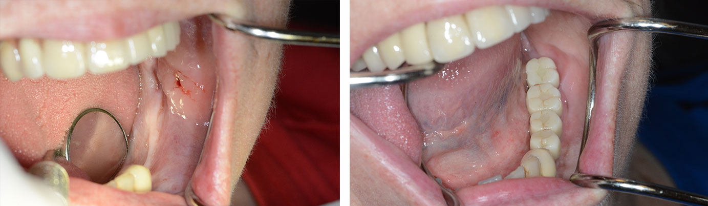 ridge graft and implants case 1 before and after
