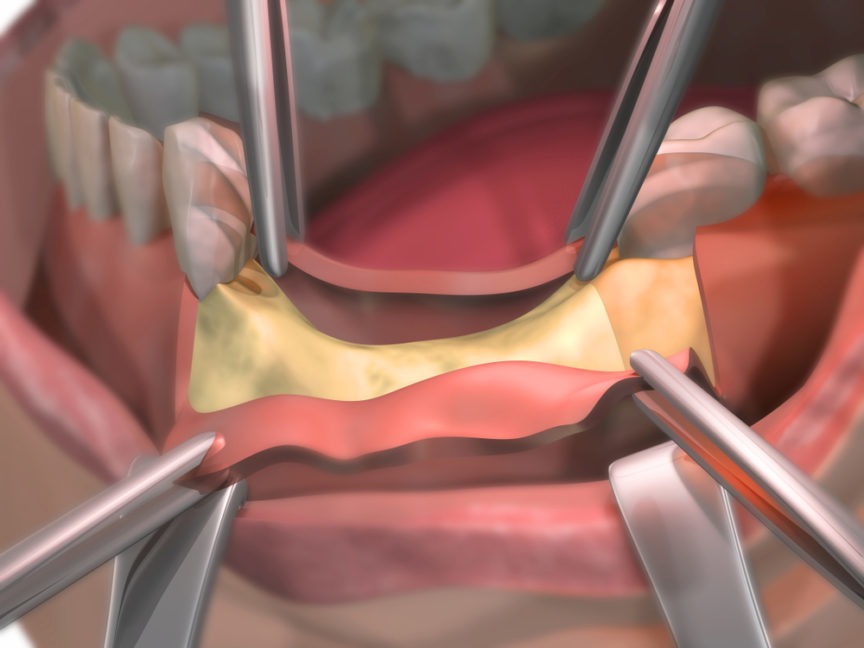 bone-grafting-for-dental-implants
