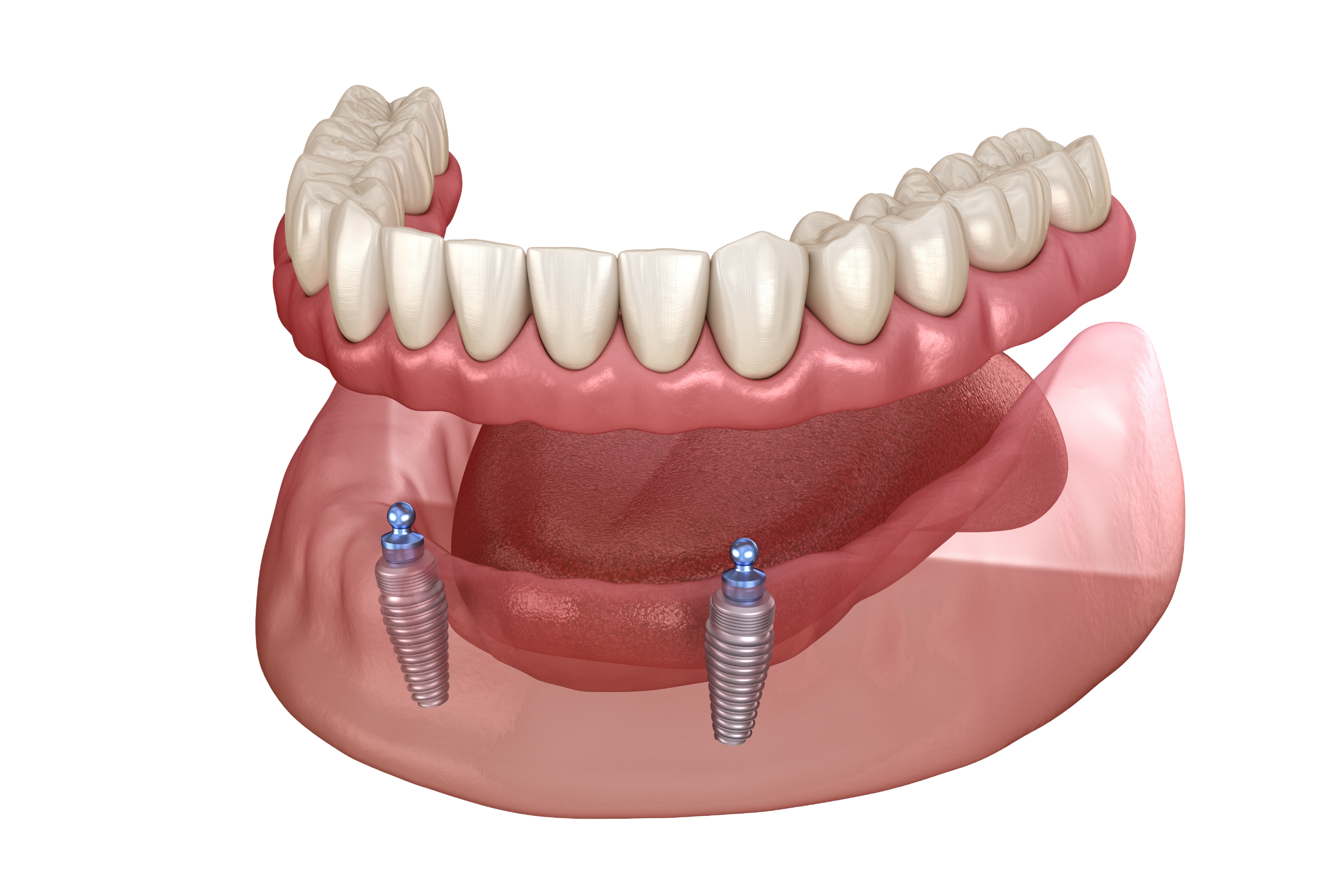implant supported denture